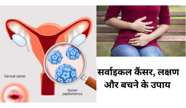सर्वाइकल कैंसर